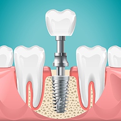 Digital illustration showing dental implants in Lady Lake
