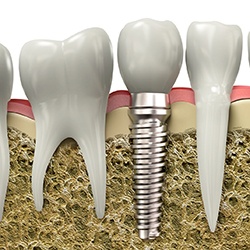 Diagram showing dental implant in Lady Lake during osseointegration 