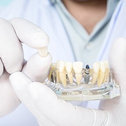 Lady Lake implant dentist holding model dental implant and jaw