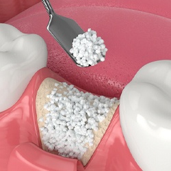 Illustration of bone grafting before dental implants in Lady Lake, FL