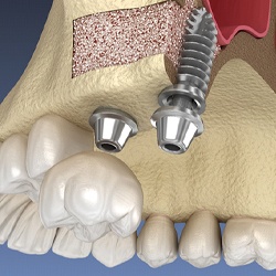 Illustration of dental implants in Lady Lake, FL after sinus lifts