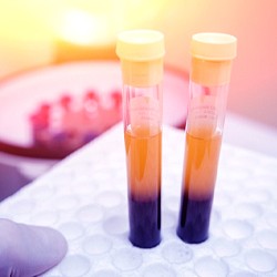 Two test tubes filled with platelet rich plasma
