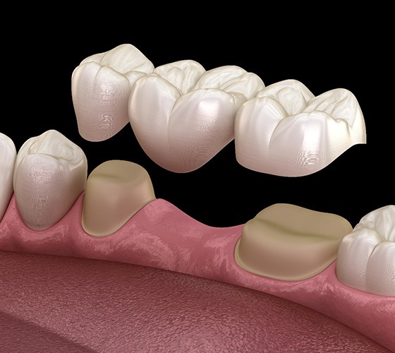 A digital image of a dental bridge going on over health teeth located on the lower arch of a person’s smile
