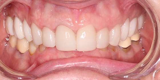 Healthy white smile after cosmetic dentistry