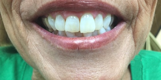 Healthy beautiful white smile after restorative dentistry