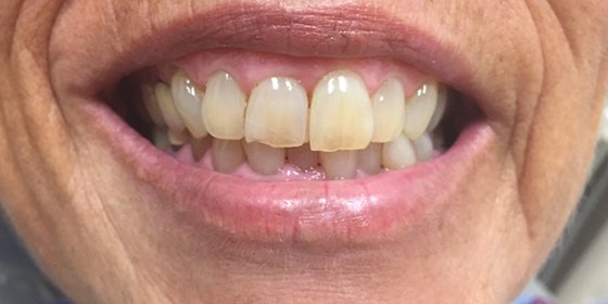 Damaged and worn teeth before restorative dentistry