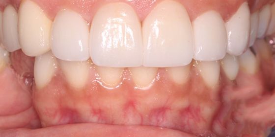 Picture perfect smile after cosmetic dentistry
