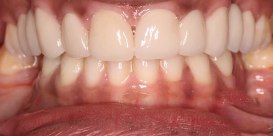 Damaged tooth replaced with flawless restoration