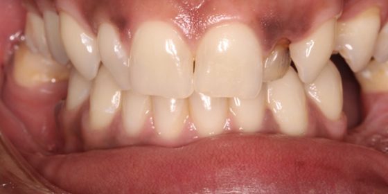 Severely damaged top side tooth