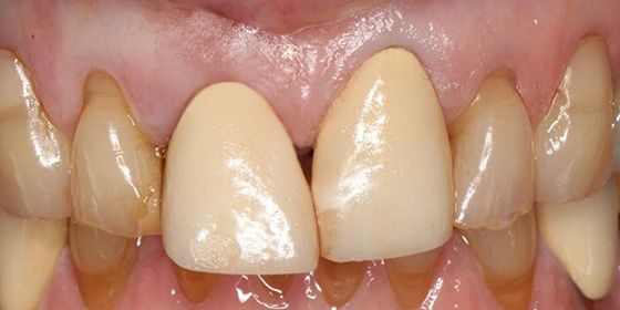 Decayed teeth and recessed gum tissue