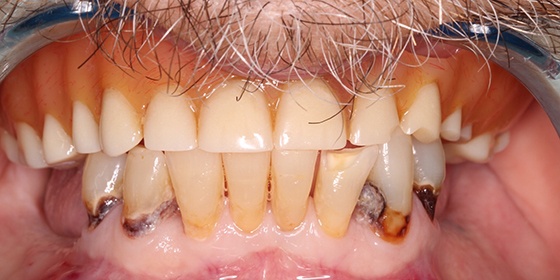 Severe tooth decay and an unnatural looking dental restoration