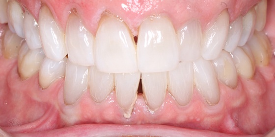 White smile after cosmetic dentistry