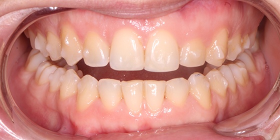 Top front tooth repaired after cosmetic dentistry