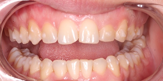Chipped top front tooth before cosmetic dentistry