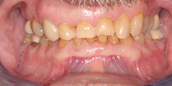 Yellowed and worn teeth before smile restoration