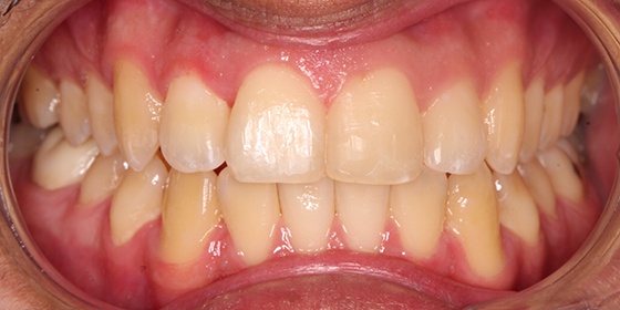 Top side tooth repaired after dental restoration