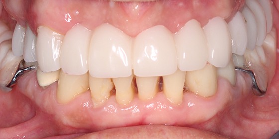 Flawless smile after partial denture tooth replacement