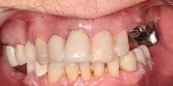 Smile with dental implant posts visible before tooth replacement