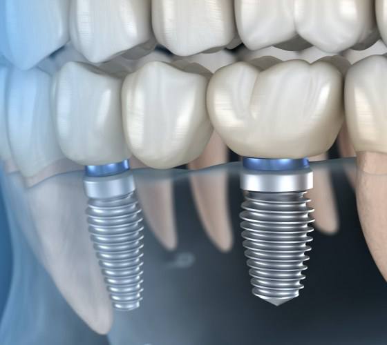 two dental implants in Lady Lake supporting a dental bridge