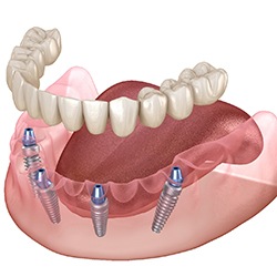 Diagram of implant dentures in Lady Lake