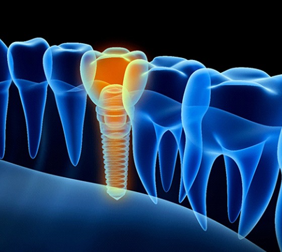 X-ray diagram of a dental implant in Lady Lake