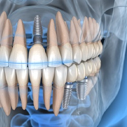 Dental implants in Lady Lake, FL spread throughout the mouth