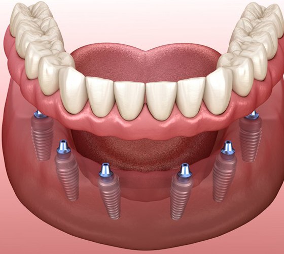 digital diagram of implant dentures in Lady Lake