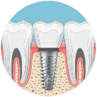 Animated dental implant with dental crown in the lower jaw