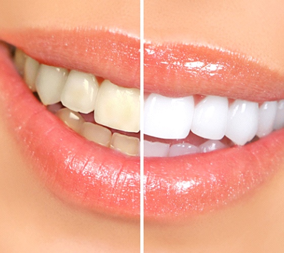Smile before and after KöR teeth whitening in Lady Lake, FL