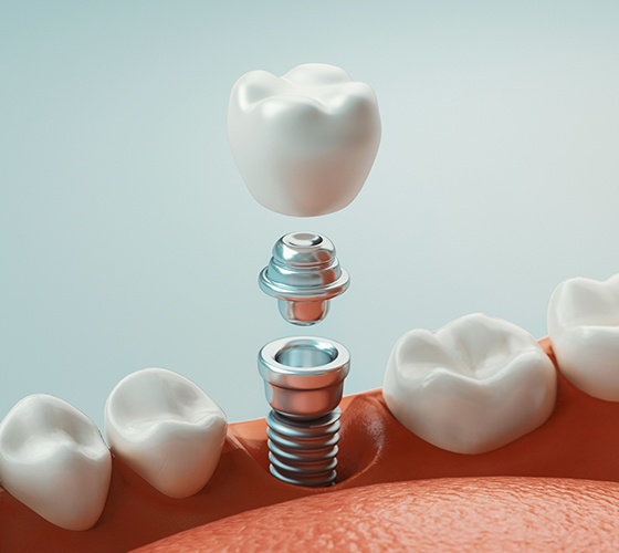 Animated dental implant used to replace missing teeth