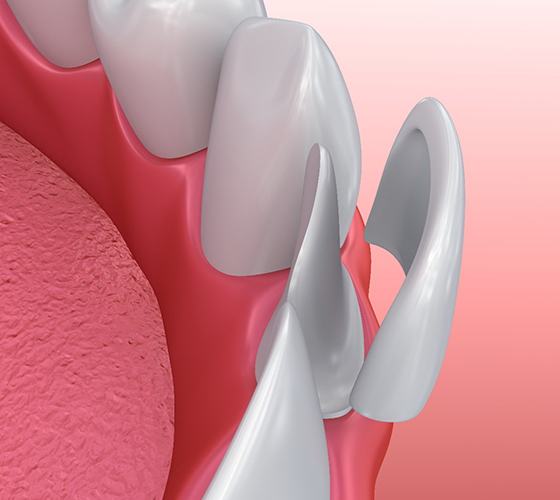 A digital image of a veneer being placed over the front surface of a tooth along the bottom arch