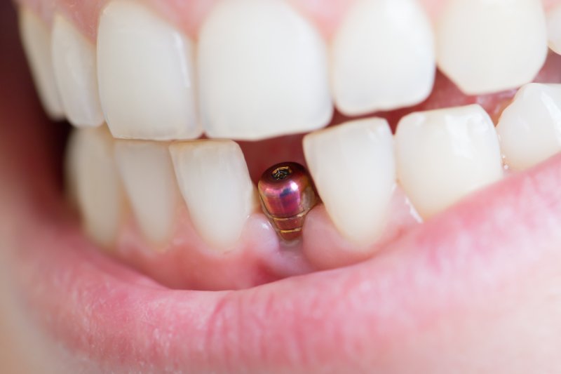 up-close look at dental implant in lower arch