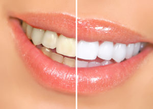 Closeup of smile after veneers or teeth whitening in Lady Lake 