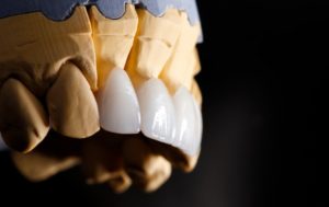 a plaster model of a mouth with dental veneers on it
